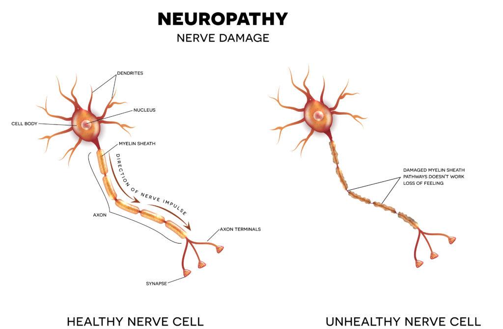 neuropathy 