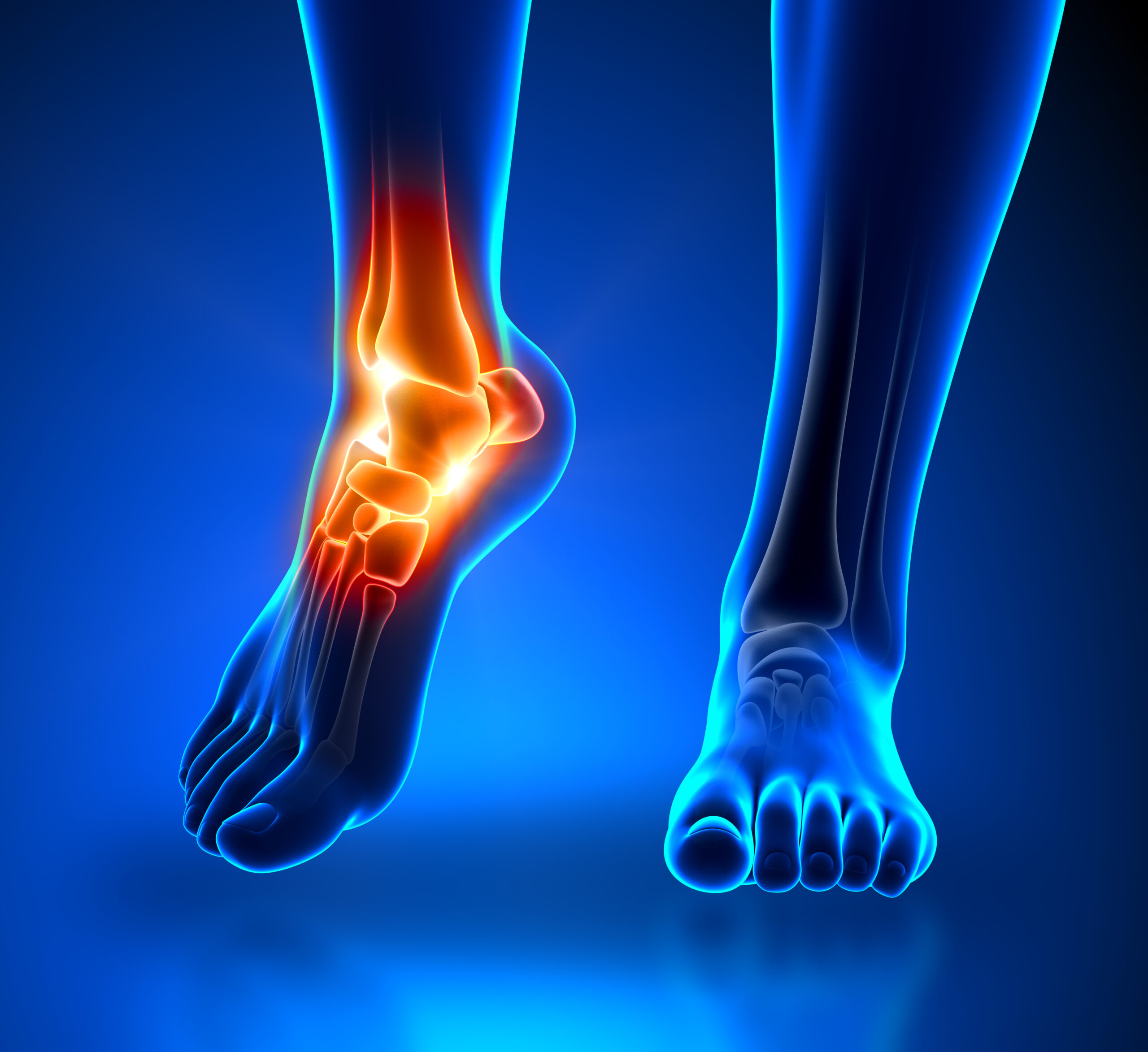 Plantar fasciitis treatment