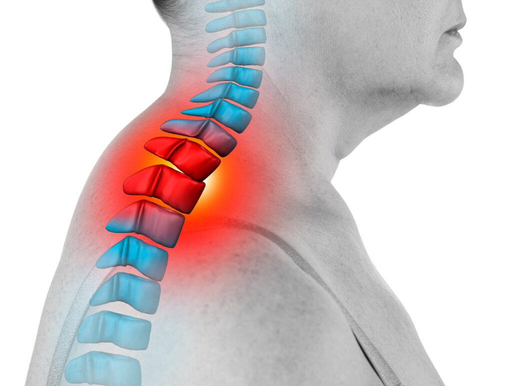 Learn How Chiropractic Care Can Improve Your Neck Hump and Forward Head Posture